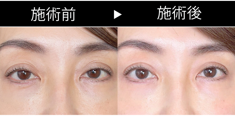 サーマクールアイビフォーアフター.png