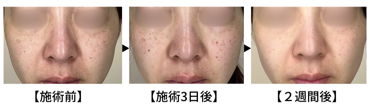 ルメッカ施術経過.png