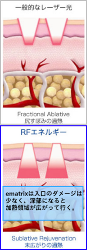 【一般的なレーザー光】尻すぼみの過熱/【RFエネルギー】e-matrixは入り口のダメージは少なく、深部になると過熱領域が広がって行く。末広がりの過熱