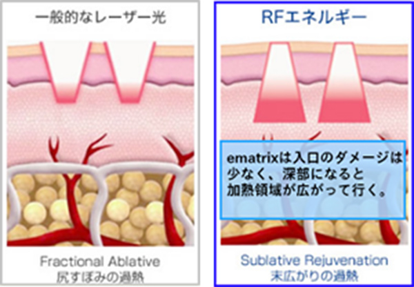 【一般的なレーザー光】尻すぼみの過熱/【RFエネルギー】e-matrixは入り口のダメージは少なく、深部になると過熱領域が広がって行く。末広がりの過熱