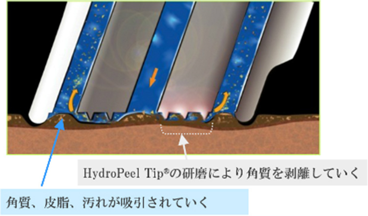 HydroPeel Tip®の研磨により角質を剥離していく / 角質、皮脂、汚れが吸引されていく