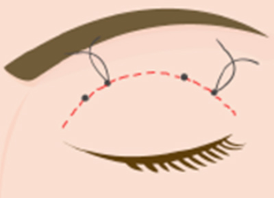 二重まぶた（埋没法）